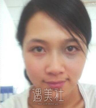 太田痣调节