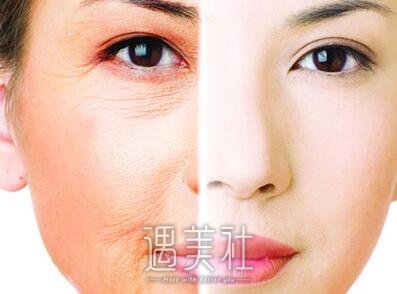 华西,光子嫩肤