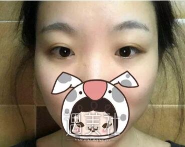 深圳北大崔永言双眼皮案例：果说明一切!