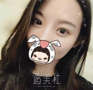 深圳北大崔永言双眼皮案例：果说明一切!
