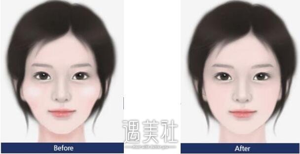 上海李湘原和李志海哪个医生磨骨好?一起来看看~