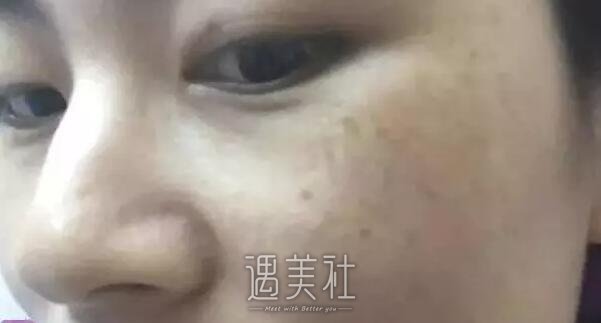 南充阿蓝整形医院祛斑怎么样?真实案例一览~