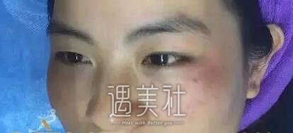南充阿蓝整形医院祛斑怎么样?真实案例一览~