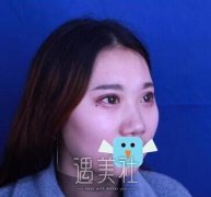 假体隆鼻一周恢复图片-来自假体隆鼻真实案例~ width=
