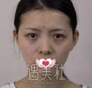 重庆章小平隆鼻技术怎么样？有近期案例蛮？ width=