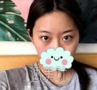 八大处石蕾双眼皮案例：双眼皮更配粉嫩的桃花妆哦~ width=
