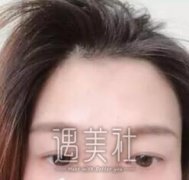 靳小雷双眼皮案例：双眼皮的女孩，才是美丽又可爱！ width=