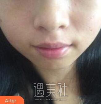 鞍钢总院,点痦子