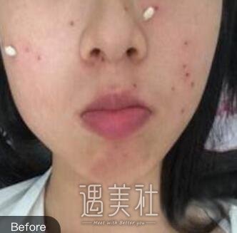 鞍钢总院,点痦子