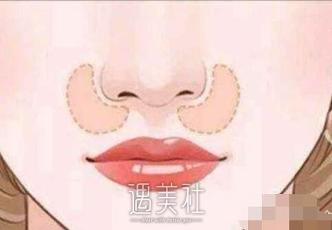 假体垫鼻基底