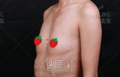 深圳徐占峰隆胸案例：感激徐医生让我重拾自信！ width=