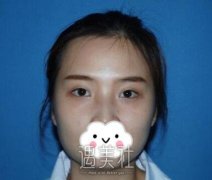 郑州杨丽双眼皮案例：形状不错是我想要的呢！ width=