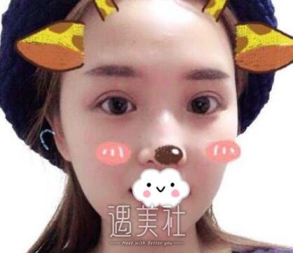 郑州,杨丽,双眼皮