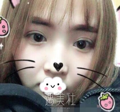 郑州,杨丽,双眼皮
