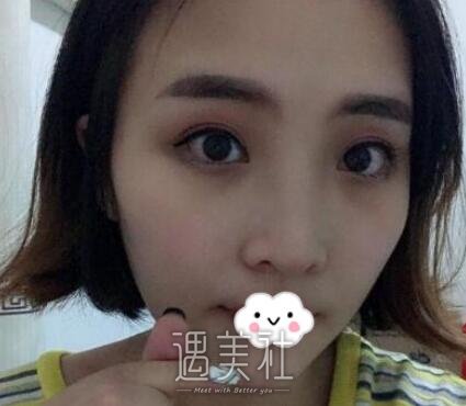 郑州,杨丽,双眼皮