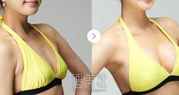 成都,自体脂肪丰胸