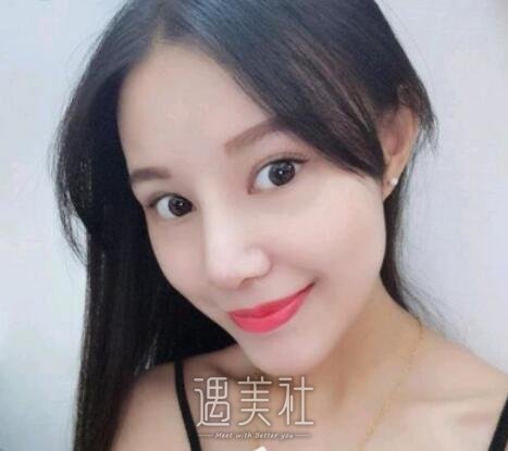 成都,米兰柏羽,隆鼻