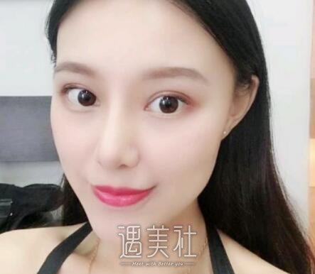 成都,米兰柏羽,隆鼻