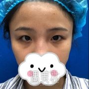 青岛伊美尔5s双眼皮多少钱?比公立医院收费贵吗? width=