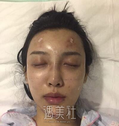 鲁树荣,脂肪填充