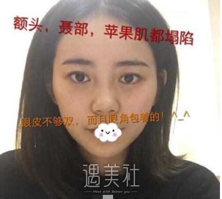 成都,华人医联,双眼皮,脂肪填充