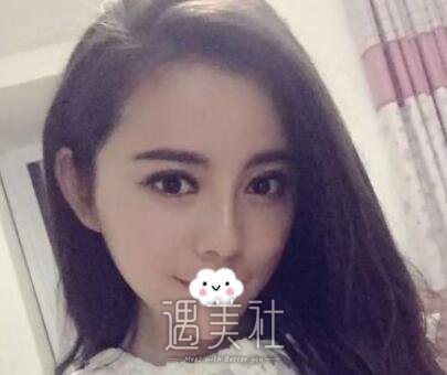 成都,华人医联,双眼皮,脂肪填充