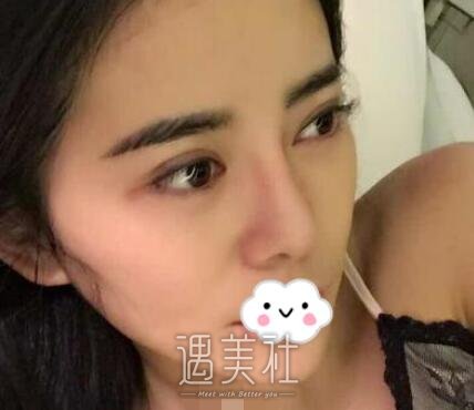 成都,华人医联,双眼皮,脂肪填充