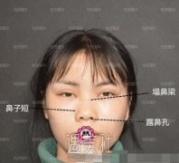 李劲良案例：隆鼻=换头？ width=