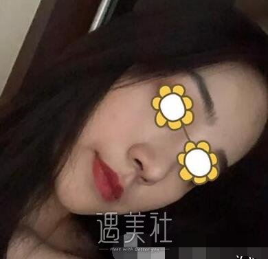 长沙,南湖,隆鼻