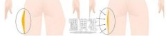 深圳做腿部抽脂手术大概多少钱?受哪些因素影响? width=