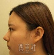 上海九医院做下颌角怎么样？磨骨真实案例详细记录~ width=