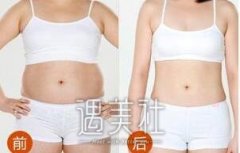 郑州抽脂价格一般是多少?受吸脂体积大小影响吗? width=