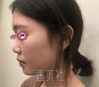 吴玉家做鼻部手术案例：颜值瞬间提升几个level！ width=