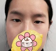 南京孙欣双眼皮做得好吗|孙欣双眼皮案例硬核力证~ width=
