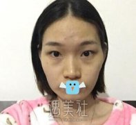 八大处张智勇颧骨内推技术好吗？恢复过程图分享~ width=