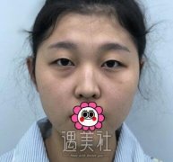 眼部手术一周恢复过程图——眼部手术真实案例全纪录~ width=
