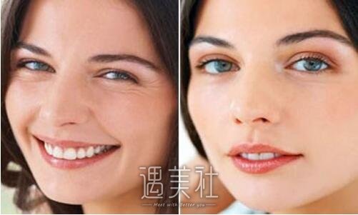 芜湖激光去鱼尾纹果怎么样，有哪些优点?