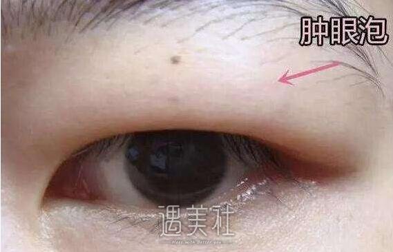 常州肿眼泡吸脂果怎么样，果好就去做?