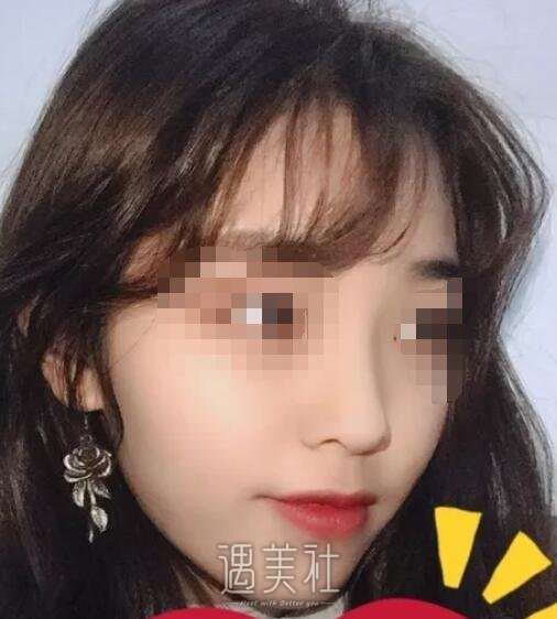爱思特胡秀龙做鼻子案例：高高挺挺的就是好看!