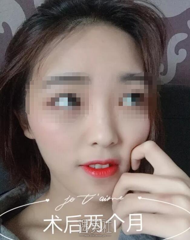 爱思特胡秀龙做鼻子案例：高高挺挺的就是好看!