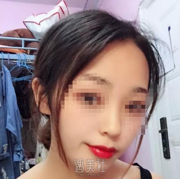 爱思特胡秀龙做鼻子案例：高高挺挺的就是好看!