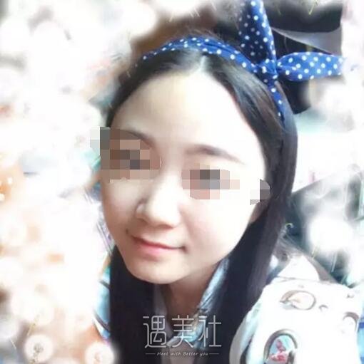 成都华美紫馨邱伟怎么样?隆鼻案例一览~