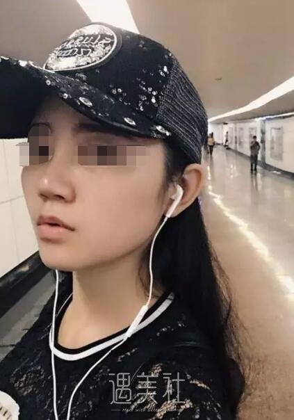 成都华美紫馨邱伟怎么样?隆鼻案例一览~