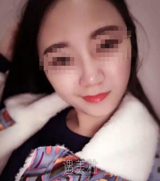 成都华美紫馨邱伟怎么样?隆鼻案例一览~