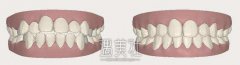 青海牙齿矫正多少钱，矫正果好不好? width=
