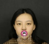 韩式开眼角果图|韩式开眼角真实日记记录~ width=