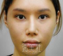 北京王军隆鼻案例：隆鼻还能使气质变得温柔呢~ width=