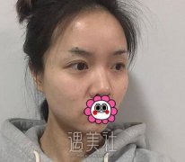王琪影做的双眼皮案例：眼睛大了就是很自信呐！ width=