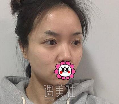 王琪影,双眼皮