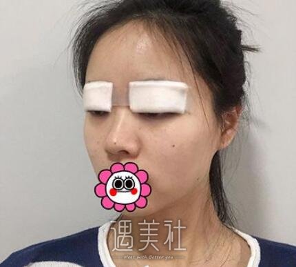 王琪影,双眼皮